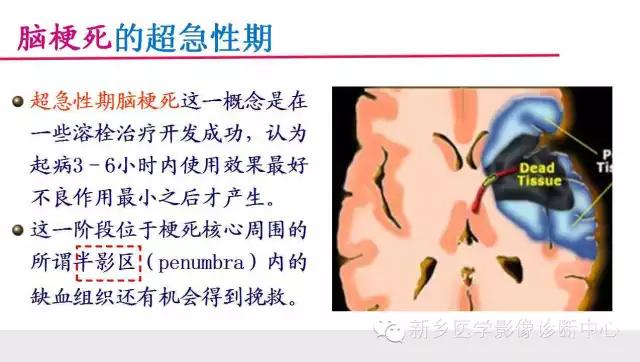 脑梗塞分期的最新标准，变化带来自信与成就感提升的重要性解读